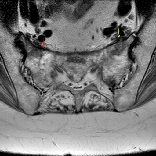 the msk playbook spinal insufficiency fractures