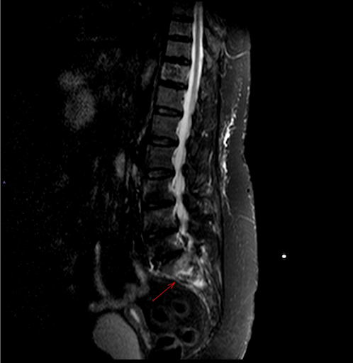 the msk playbook spinal insufficiency fractures
