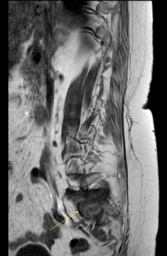 the msk playbook spinal insufficiency fractures